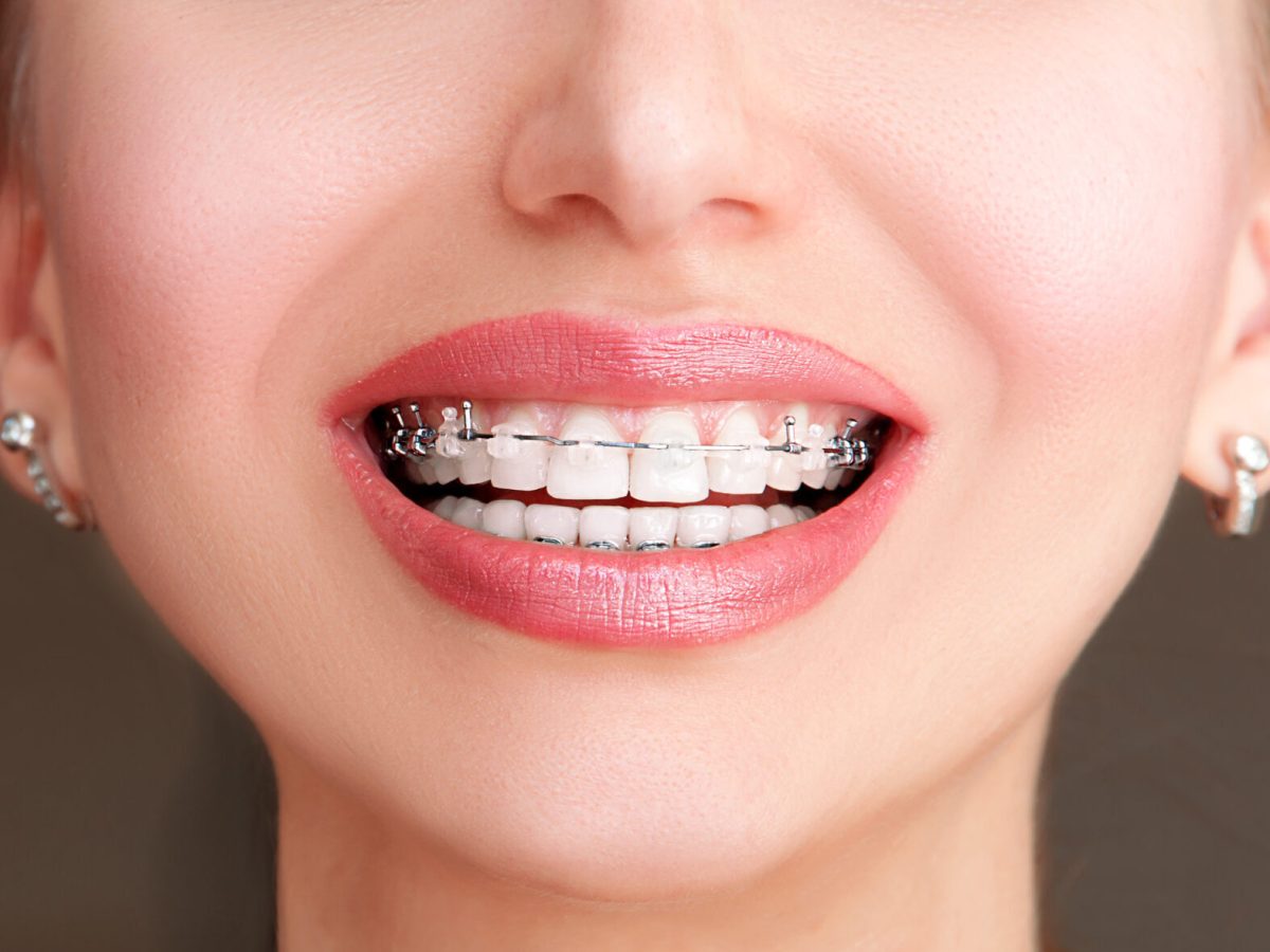 Close up open mouth with Ceramic and Metal Braces on beautiful Teeth. Broad Smile with Self-ligating Brackets. Orthodontic Treatment. Woman Smiling Showing Dental Braces.